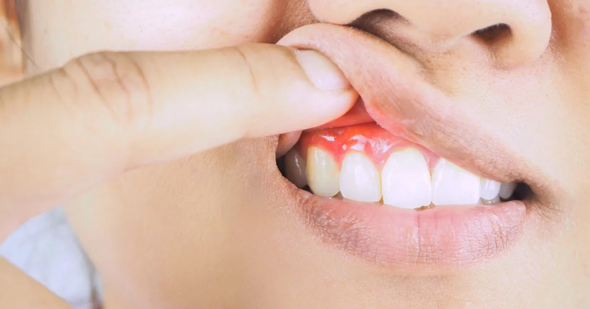 Gum Disease Explained: From Causes to Treatment